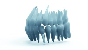 prix moyen implant dentaire