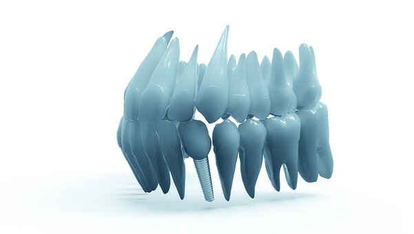 Quel est le prix moyen d’un implant dentaire et est-ce qu’il est remboursé ?