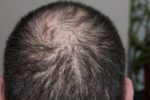 Chute des cheveux : qu’est-ce que la greffe FUE ?